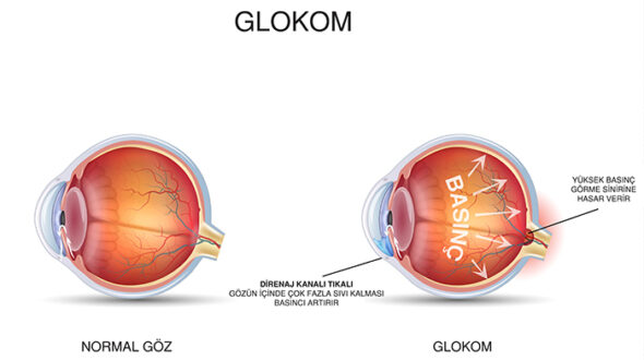GLOKOM